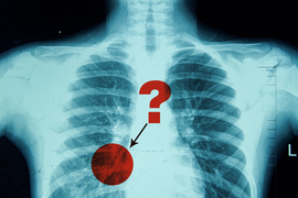 A chest X-ray with an area of uncertainty